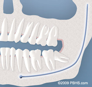 An example of a wisdom tooth with a partial bony impaction